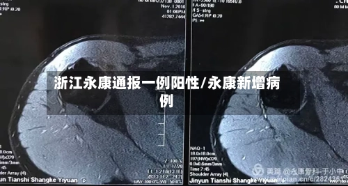 浙江永康通报一例阳性/永康新增病例
